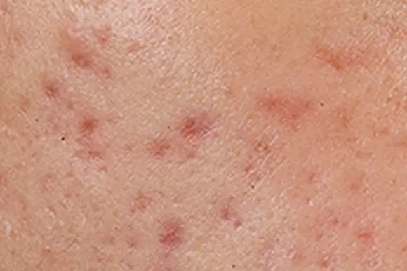Close-up of reduced-looking blemishes after using the Eucerin Probiom8 kit for 5–8 weeks
