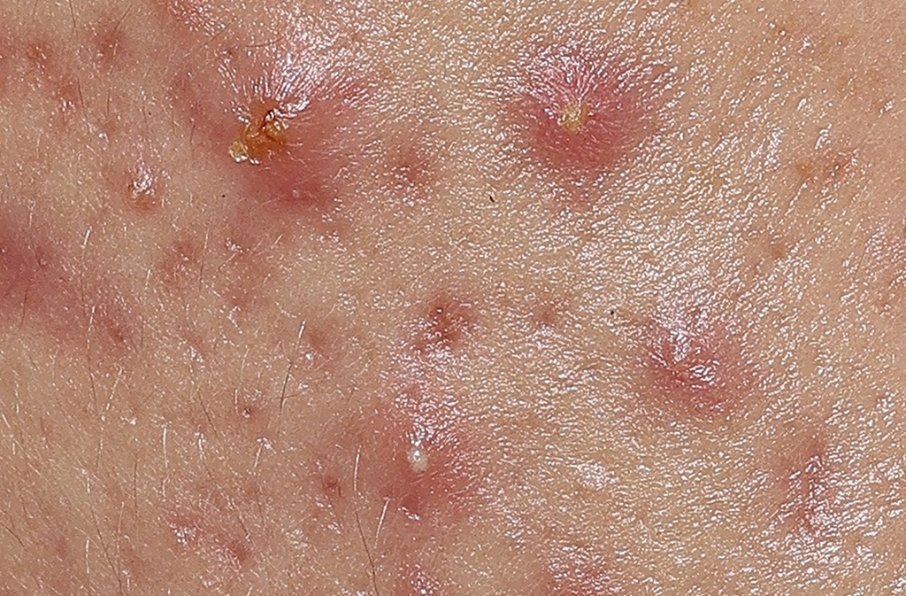 Nahaufnahme von entzündeten Akne-Hautunreinheiten vor der Anwendung des Eucerin Probiom8-Sets