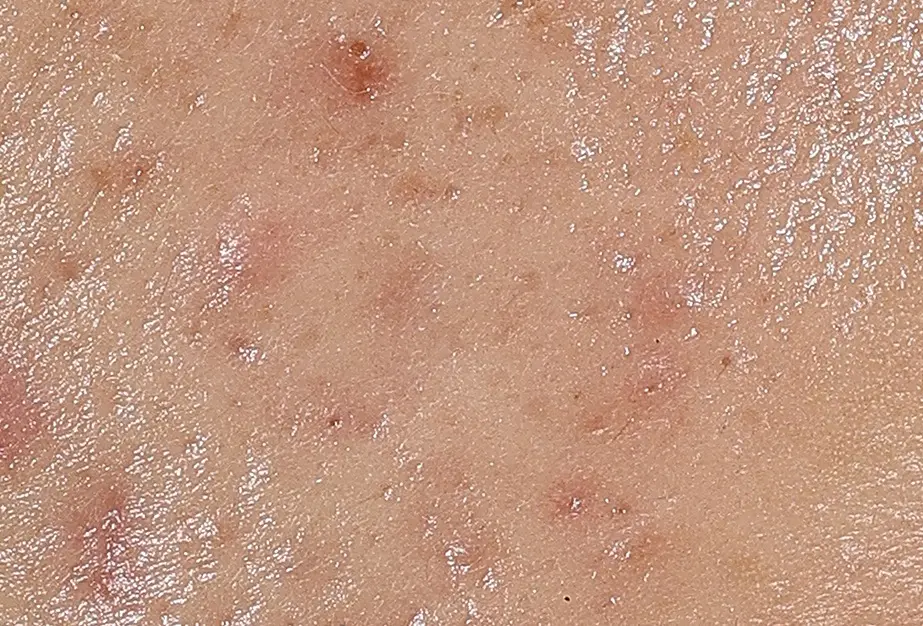 Close-up of reduced-looking blemishes after using the Eucerin Probiom8 kit for 3-4 weeks