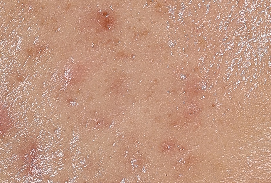 Primer plano de imperfecciones de acné reducidas tras usar Eucerin Probiom8 durante 3–4 semanas