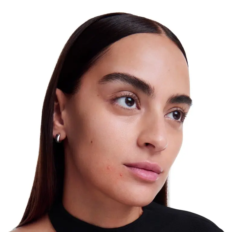 Woman's face with acne-prone skin and visible blemishes