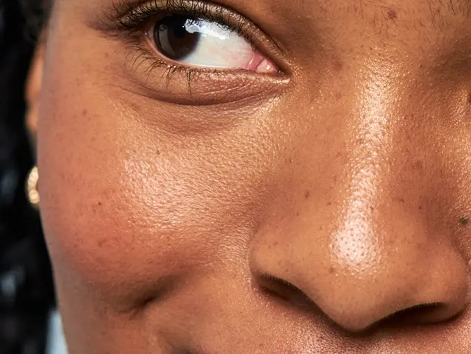 Close up of a woman's face with dark spots