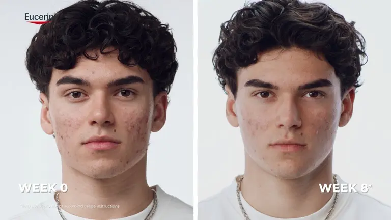 Real results: Before and after images showing reduced-looking acne blemishes after using the Eucerin Probiom8