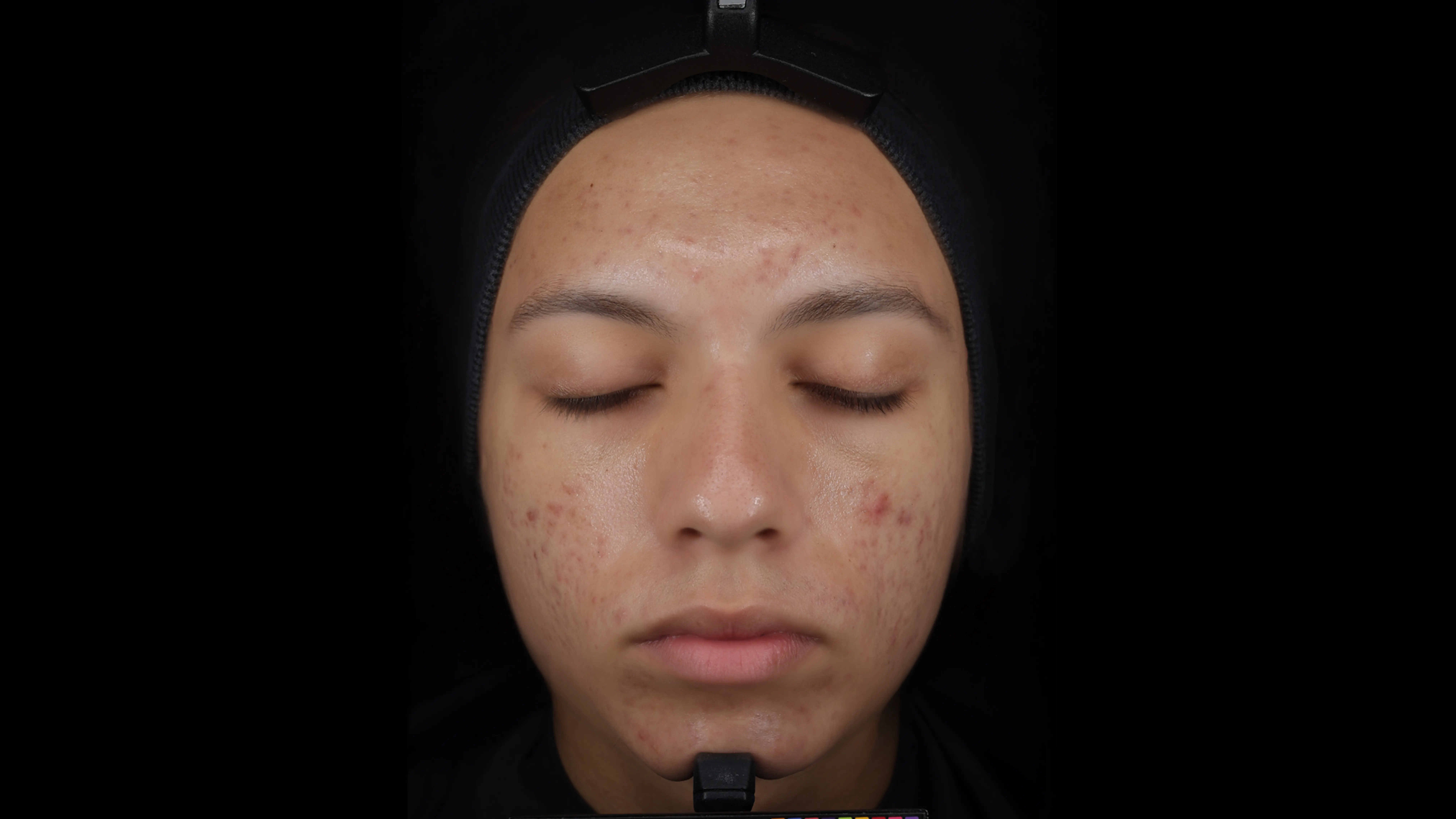 After using the Eucerin Probiom8 kit, with reduced-looking blemishes