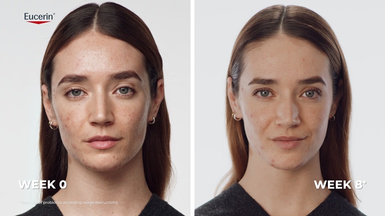 Echte Ergebnisse: Vorher-Nachher-Bilder, die zeigen, dass Akne-Hautunreinheiten nach der Anwendung von Eucerin Probiom8 weniger sichtbar erscheinen