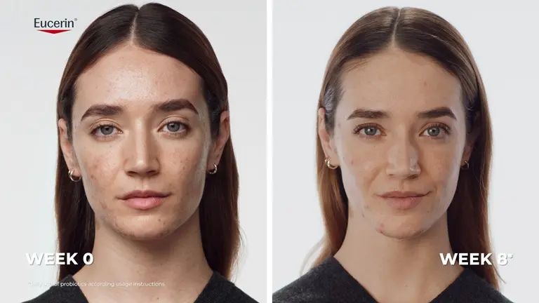 Real results: Before and after images showing reduced-looking acne blemishes after using the Eucerin Probiom8Real results: Before and after images showing reduced-looking acne blemishes after using the Eucerin Probiom8