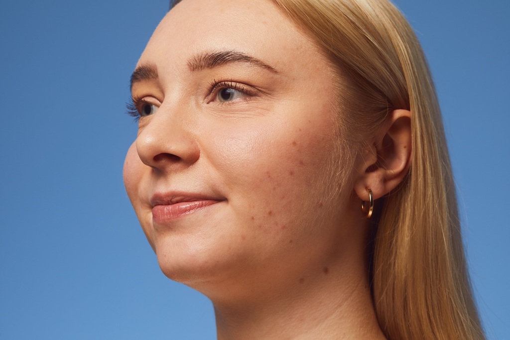 young woman using NIVEA DermaSkin product