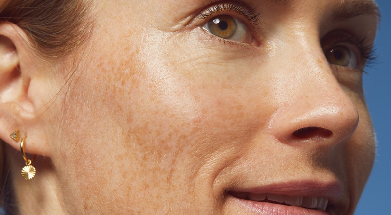 Woman's face with aging skin and age spots