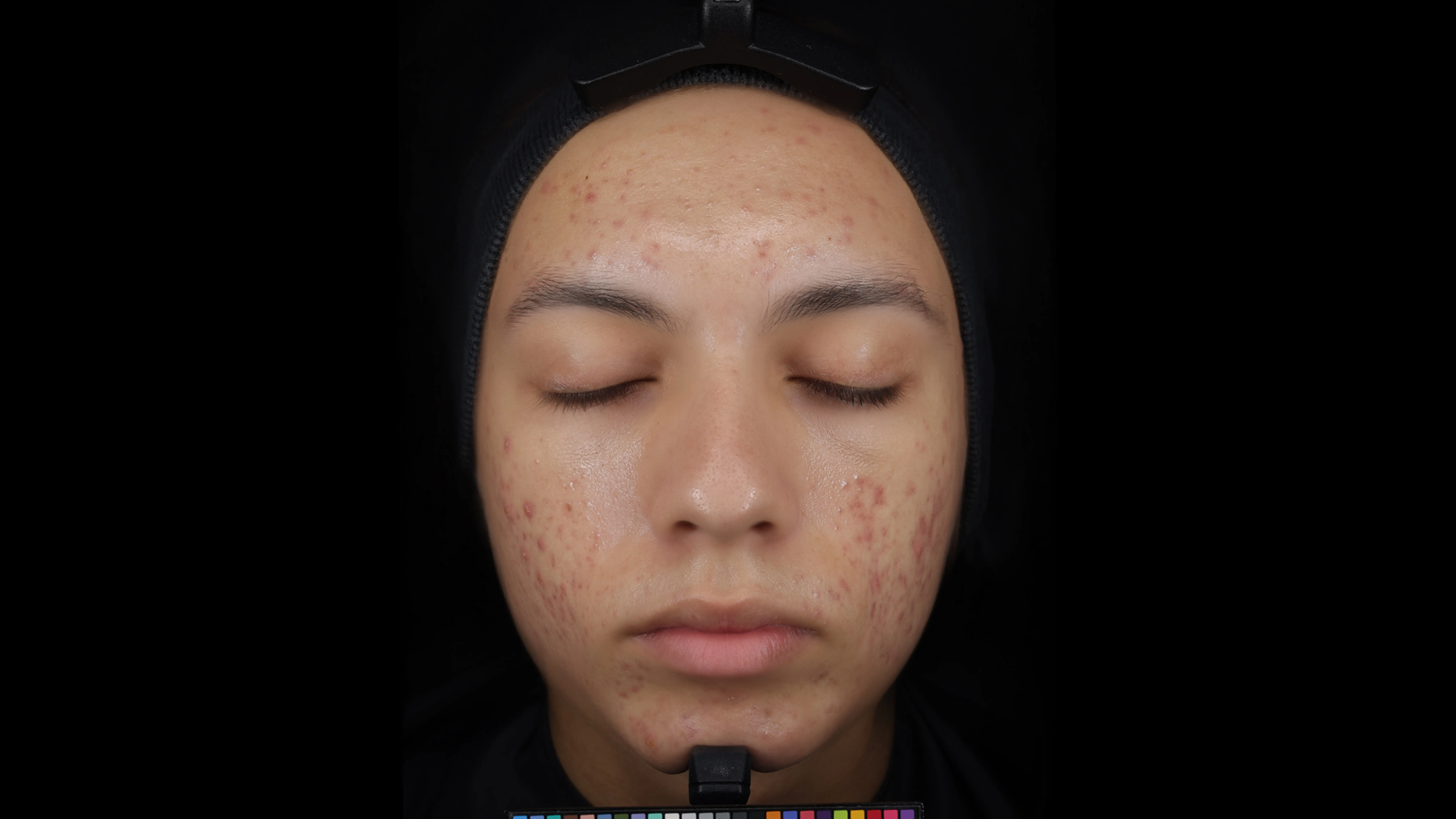Before using the Eucerin Probiom8 kit, with visible blemishes