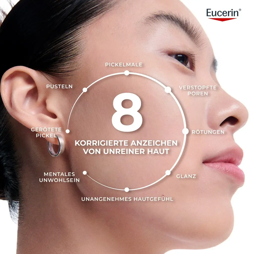 Gesicht einer Frau mit Infografik: 8 Anzeichen für behobene Akne: Aknenarben, Poren, Rötungen, fettige Haut, Hautbeschwerden, psychische Beschwerden sowie rote und weiße Pickel