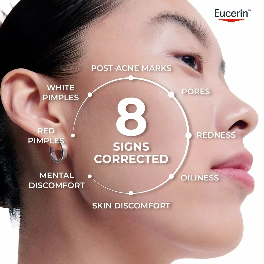 Woman's face with infographic: 8 signs of acne corrected: post-acne marks, pores, redness, oiliness, skin discomfort, mental discomfort and red and white pimples