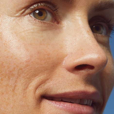 Woman's face with aging skin and age spots
