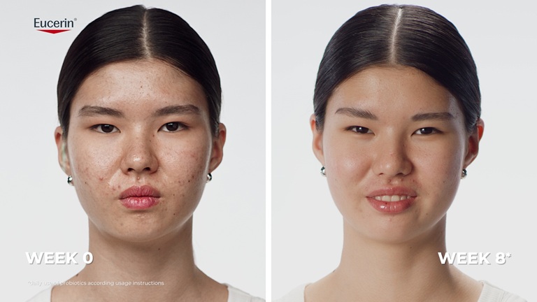 Echte Ergebnisse: Vorher-Nachher-Bilder, die zeigen, dass Akne-Hautunreinheiten nach der Anwendung von Eucerin Probiom8 weniger sichtbar erscheinen