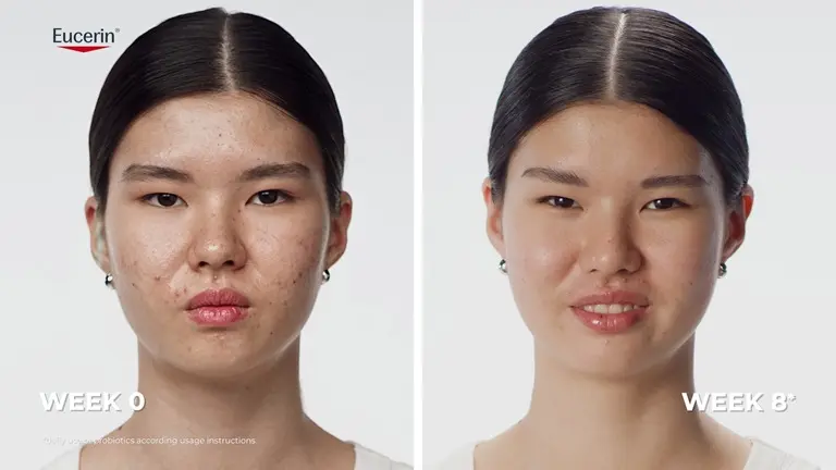 Real results: Before and after images showing reduced-looking acne blemishes after using the Eucerin Probiom8