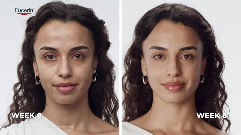 Real results: Before and after images showing reduced-looking acne blemishes after using the Eucerin Probiom8