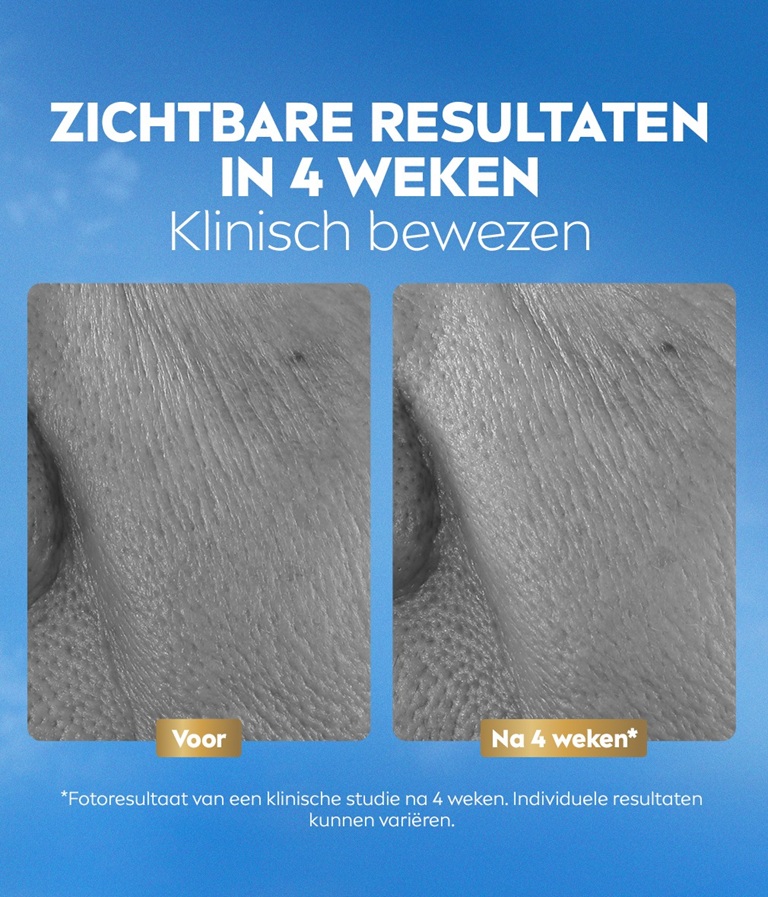Vergelijkende close-upfoto van de huid vóór en na, met de tekst “Zichtbare resultaten in 4 weken”.