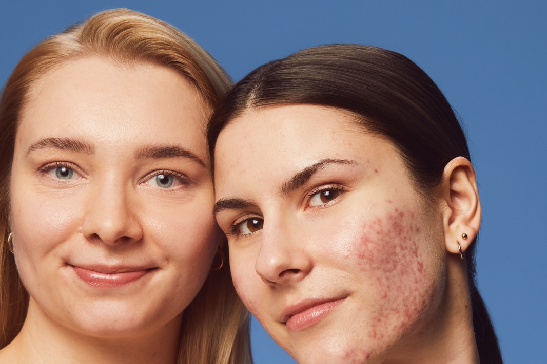 young woman using Nivea Derma Skin Exfoliator