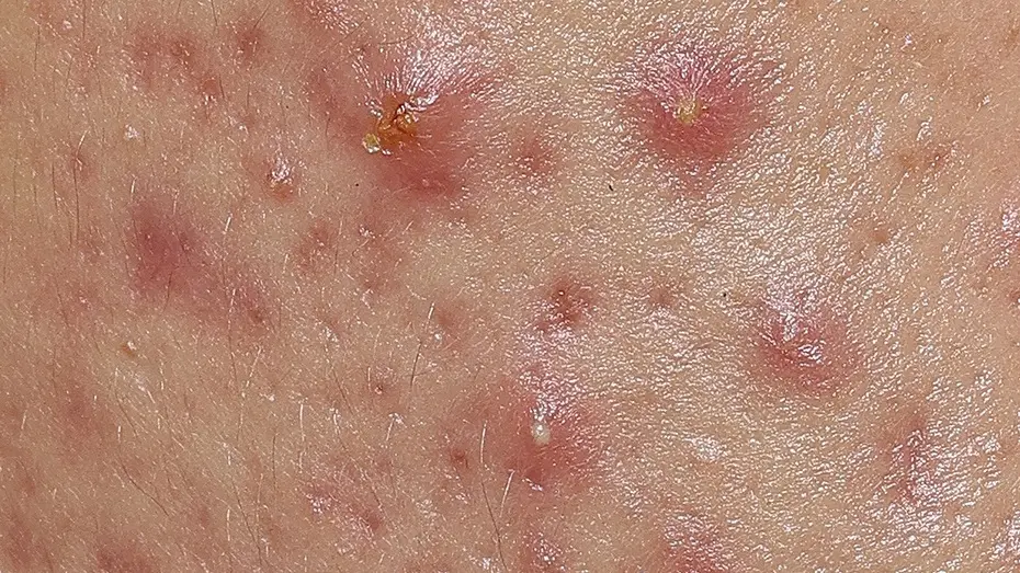 Close-up of inflamed acne blemishes on skin before using the Eucerin Probiom8 Kit
