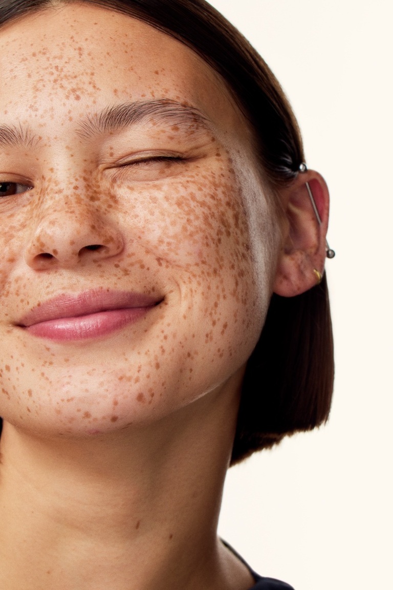 smiling Girl with sun spots