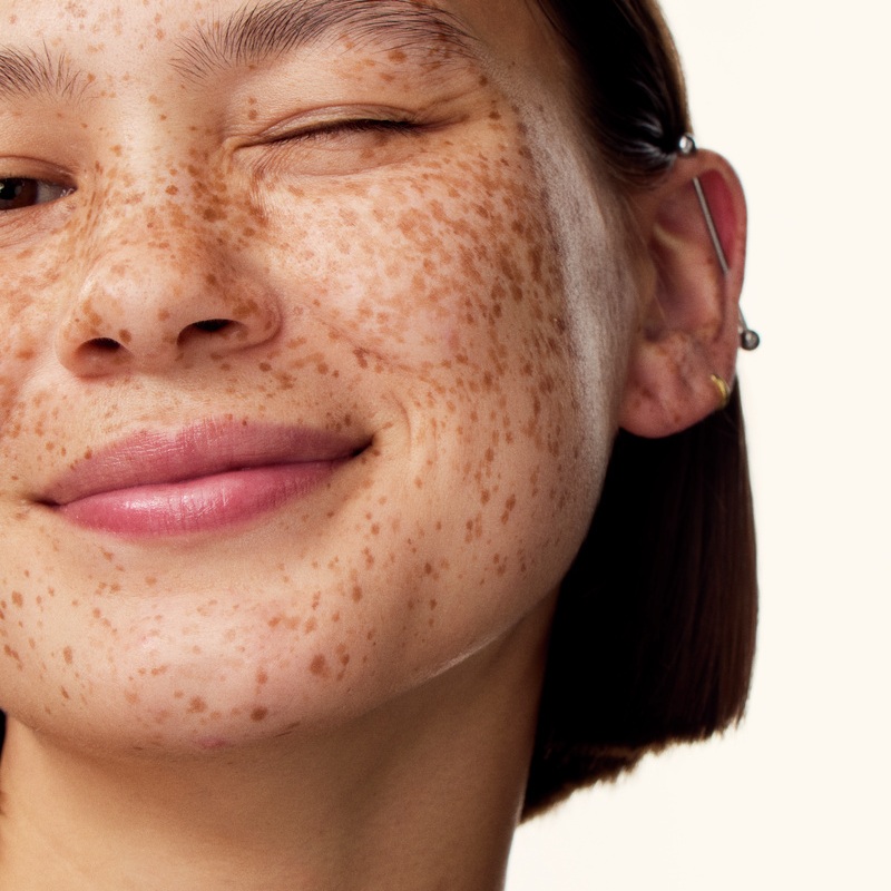 smiling Girl with sun spots