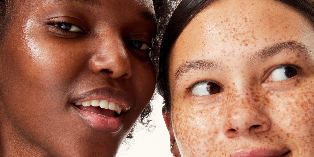 two young girls one with sun spot