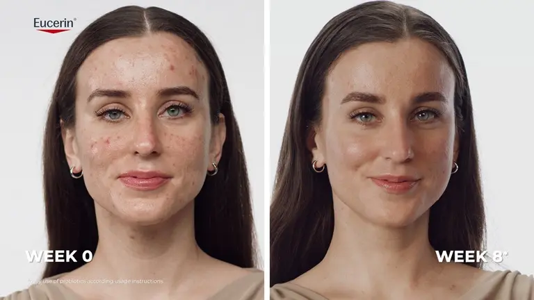Real results: Before and after images showing reduced-looking acne blemishes after using the Eucerin Probiom8